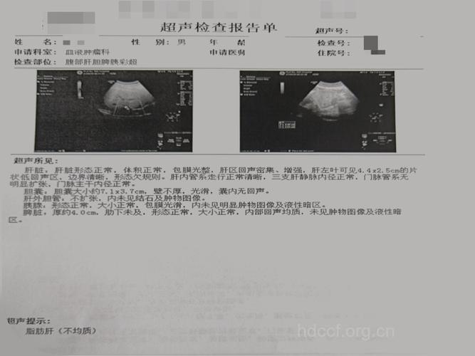酒精性脂肪肝病例