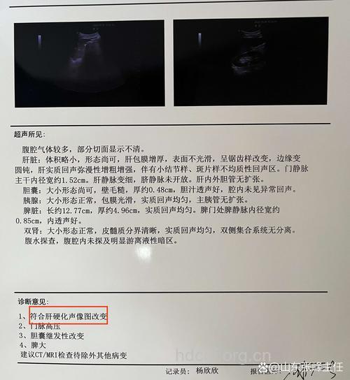 一个年仅27岁的年轻肝硬化病例