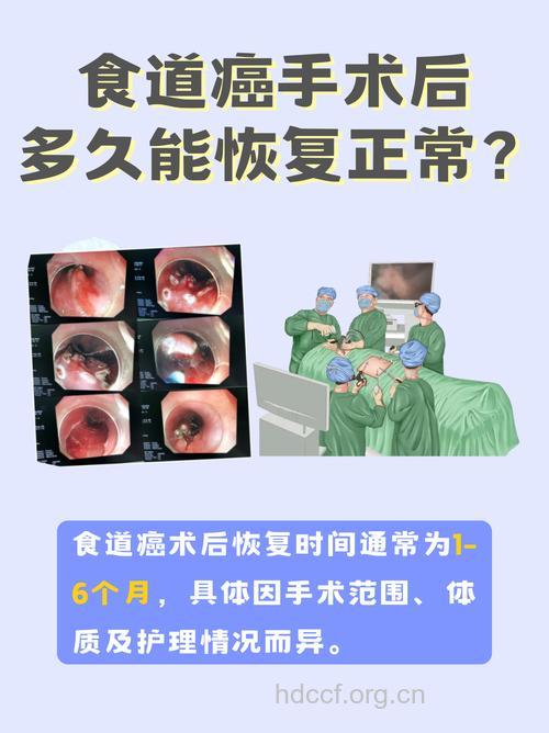 如何治疗食道癌才能更好的恢复