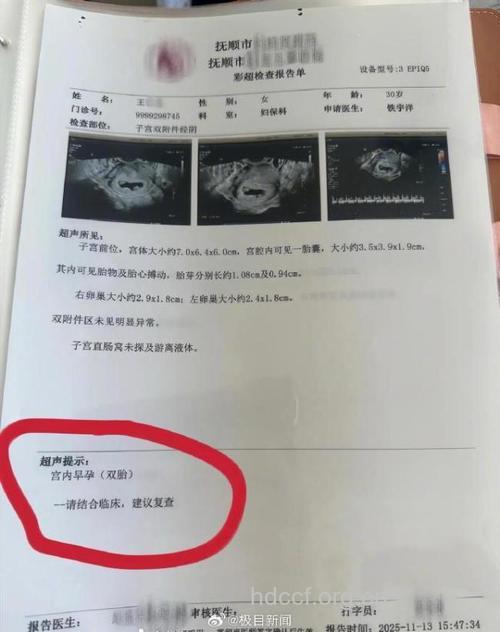 孕妇B超单中的V字是什么意思