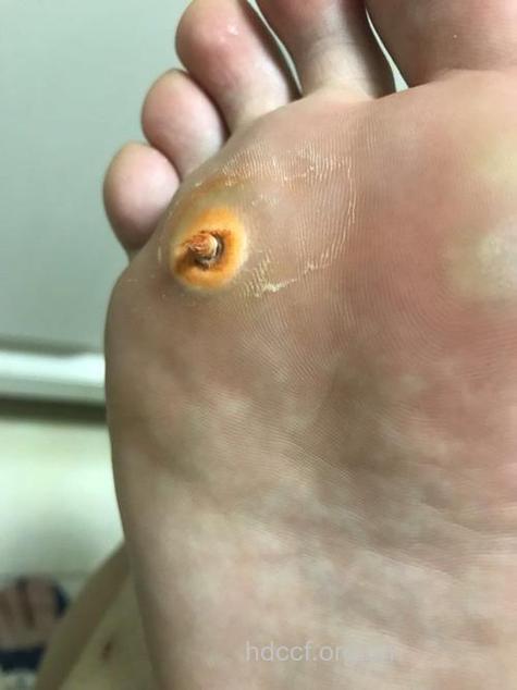 鸡眼怎么治疗 常见的大蒜就能治疗