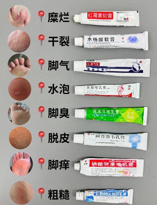 脚部有湿气容易长癣 二黄汤泡脚能去脚气