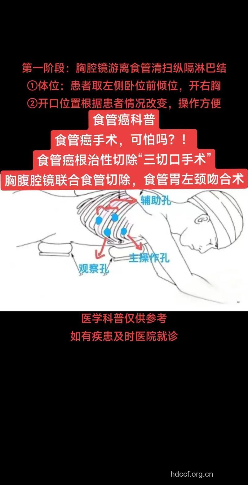 食道癌的内镜下治疗方式