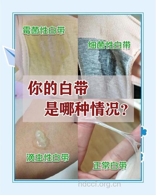 白带异常的五大迹象