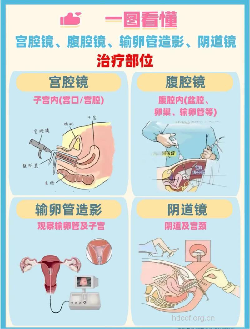 妇科病逃不过腹腔镜的法眼！