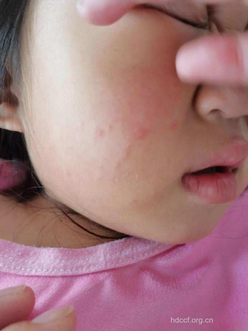 宝宝患上手足口病 脸上会出疹子吗