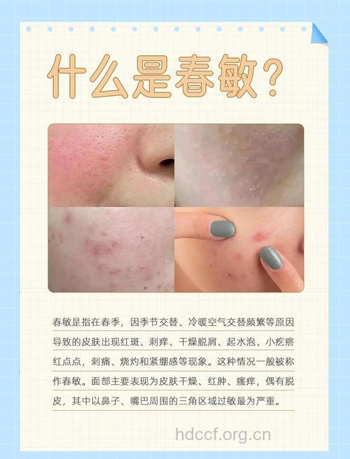 春季皮炎高发 注意4个预防要点