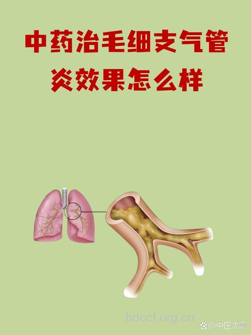患上毛细支气管炎 中西结合治疗效果好