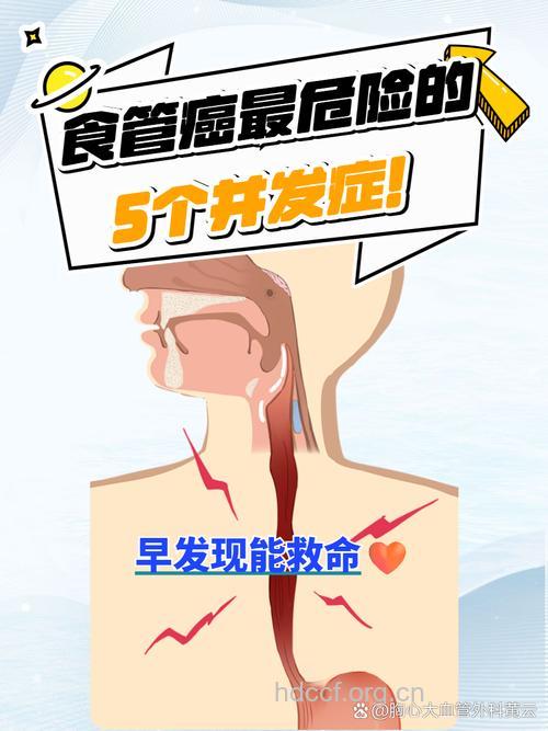 最为主要的食道癌的并发症