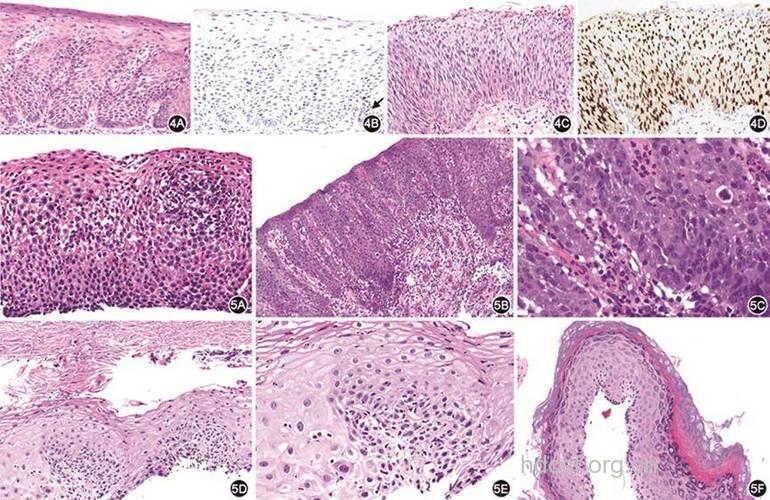 食管癌病理是怎么样的