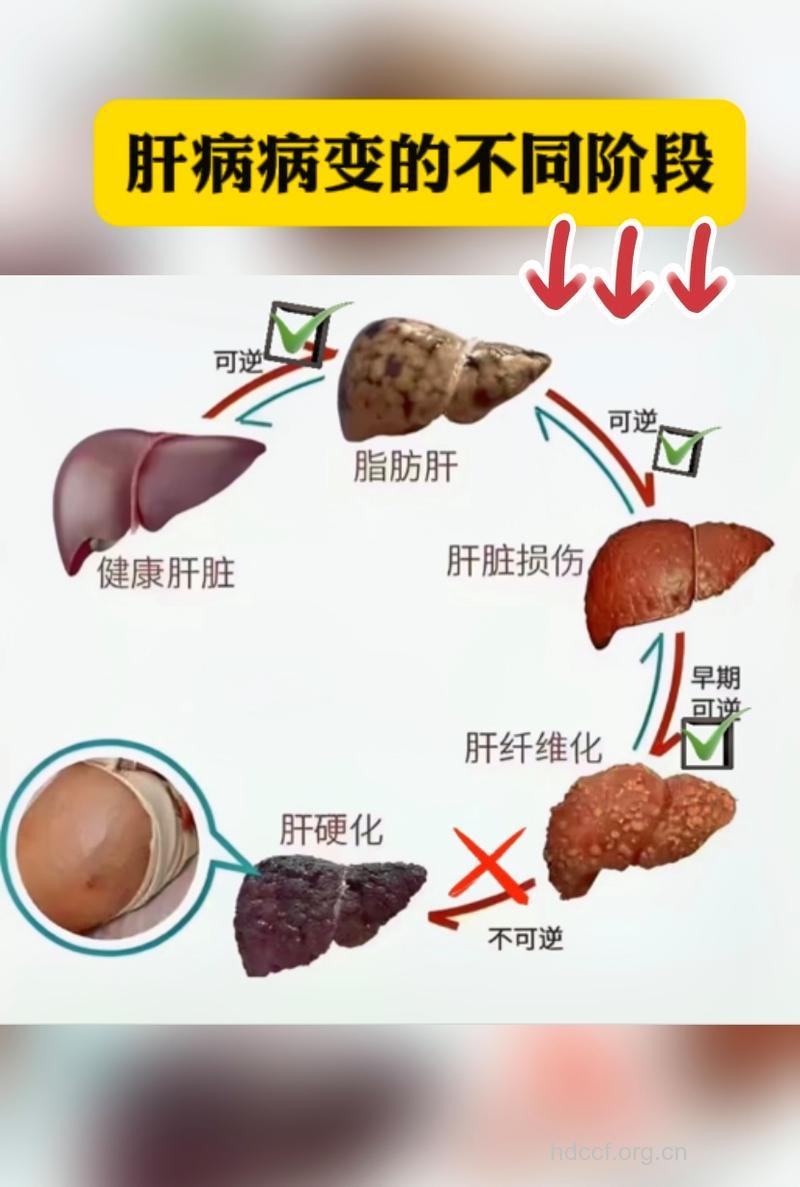 什么样的体质易患脂肪肝?