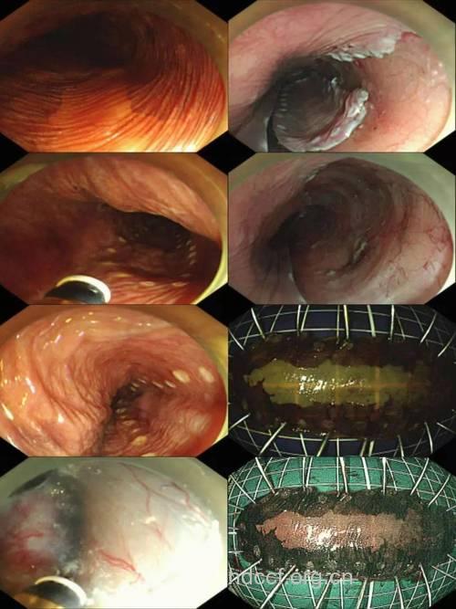 食道良性肿瘤有哪些症状