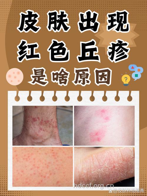 小心！秋季容易出现四种皮肤病