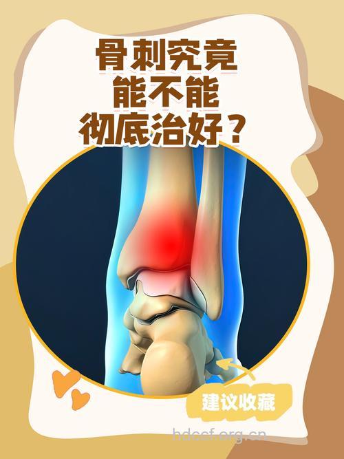 患有骨刺最好不要动?这种观点是错的