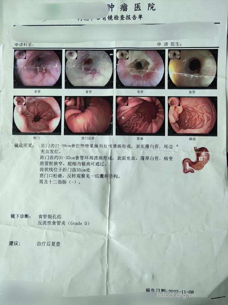 晚期食道癌有什么症状