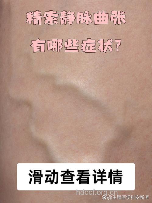 精索静脉曲张有什么发病特点