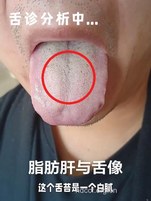 10大舌尖上的脂肪肝症状