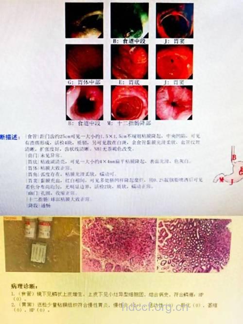 食道癌发病病理是什么