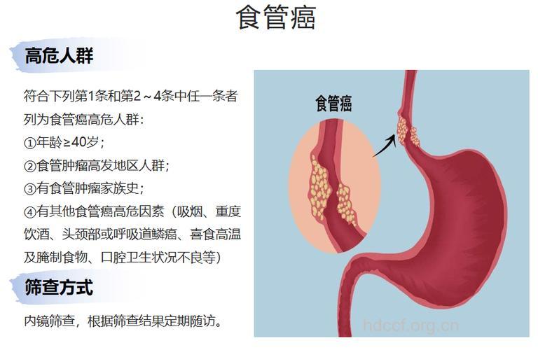 食道癌的高危人群有哪些
