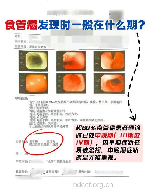 食道癌高危人群是哪些