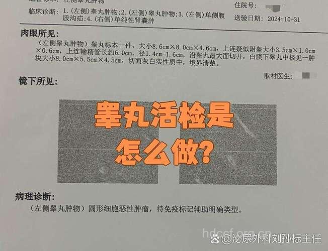怎么认识睾丸活检