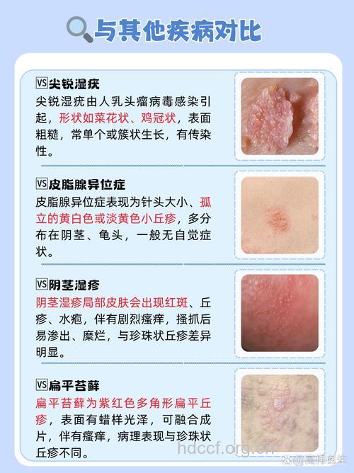 如何诊断阴茎珍珠疹