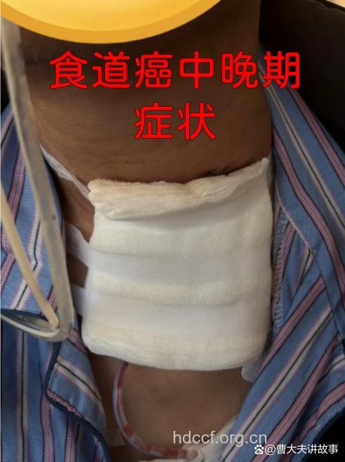 食道癌晚期死前症状表现