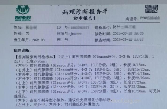 直肠指检有效诊断前列腺癌
