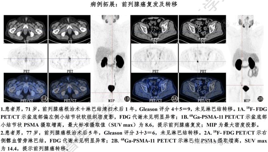 CT检查辅助诊断男人前列腺癌