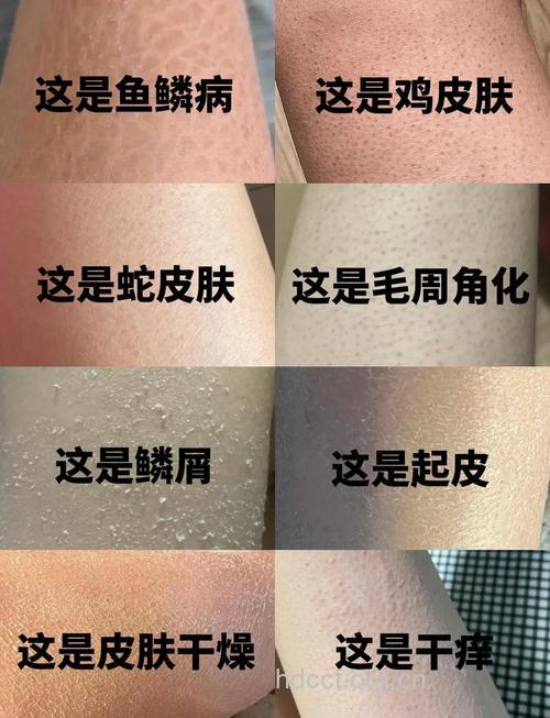鱼鳞皮肤病怎么破 中医六个妙招能祛除