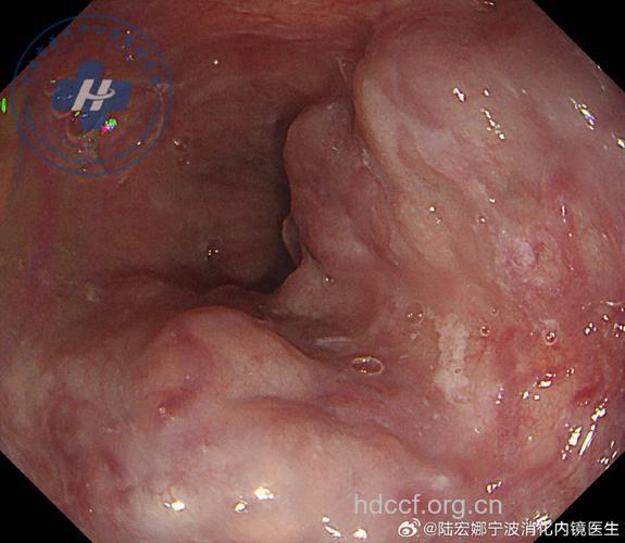 食道癌晚期会有什么明显症状呢
