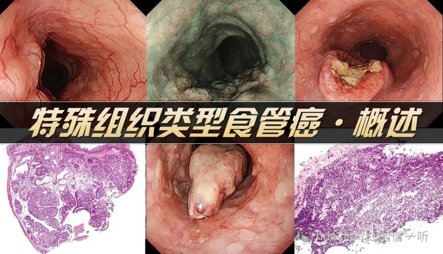 食管癌症状都有哪些呢
