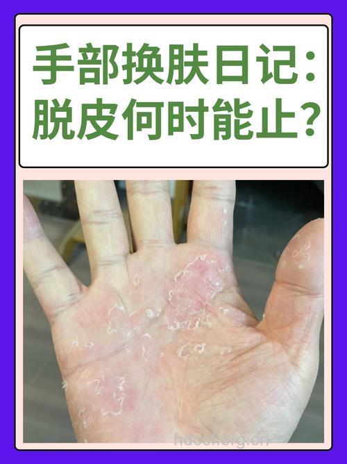 手掌脱皮是怎么回事