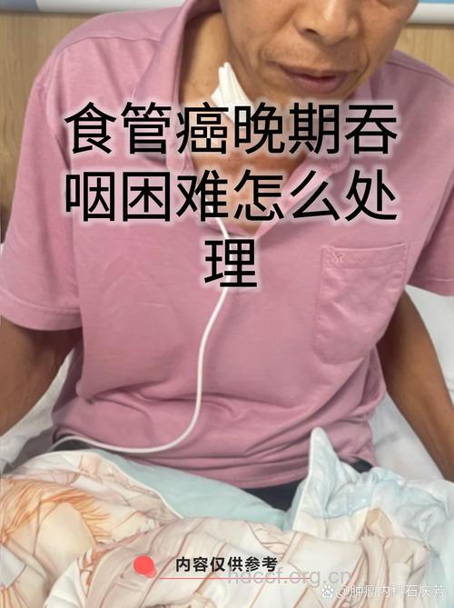 食道癌晚期吞咽困难怎么办