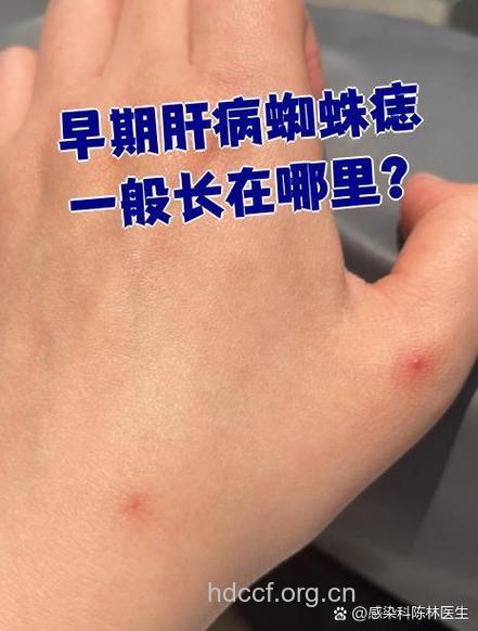 脂肪肝会不会出现蜘蛛痣?