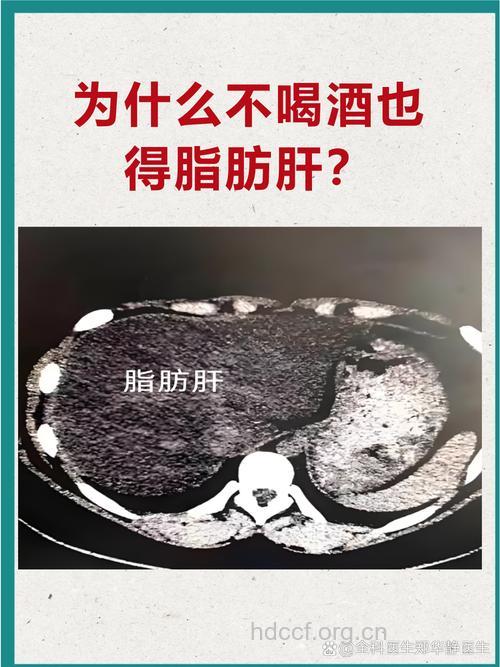 不喝酒也能得脂肪肝