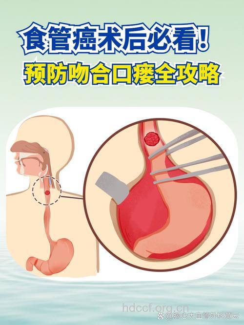 怎么避免食道癌手术后感染