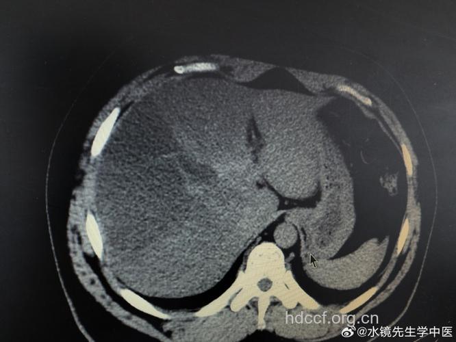 “扭”“扭”“扭”掉脂肪肝