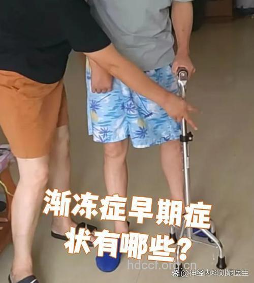 ALS渐冻人早期典型症状