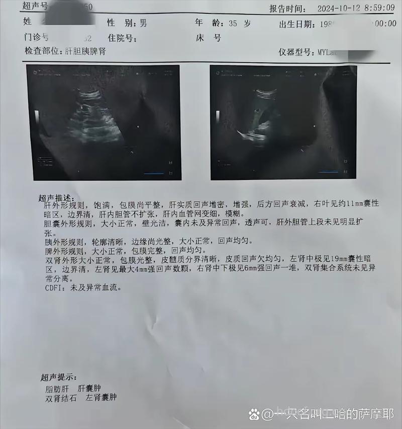 脂肪肝的检查诊断