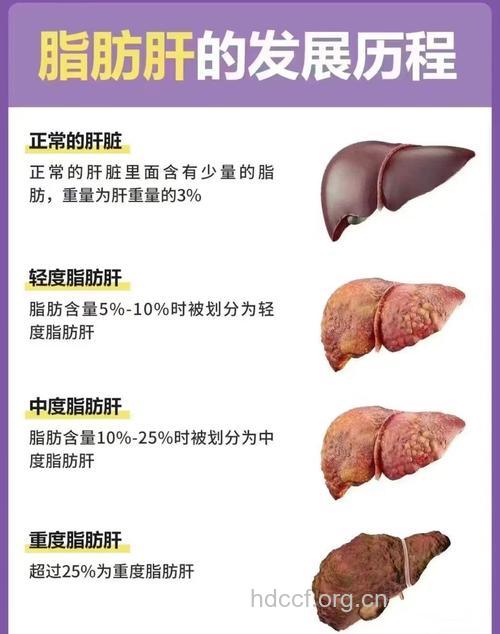 脂肪肝的下一步是肝硬化