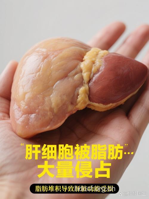 一位大学生的脂肪肝