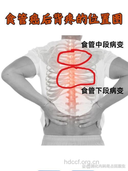 胸骨疼痛是食道癌症状吗