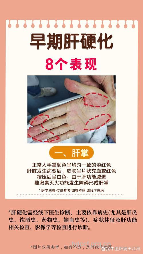 四大观察最早察觉肝硬化