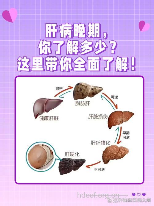 肝硬化晚期会有这4个症状