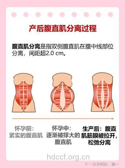 孕妇肌肉拉伤 你了解吗