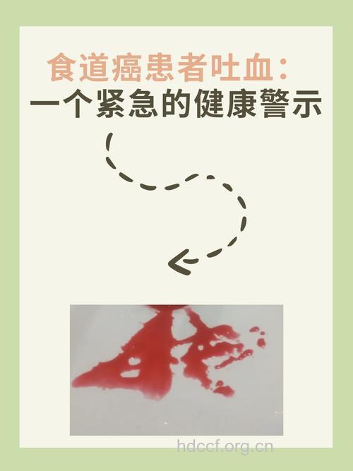 食道癌呕吐怎么回事