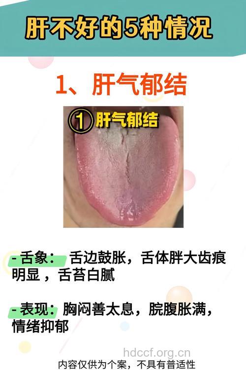 舌炎是肝硬化的症状吗