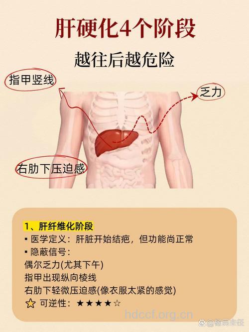 肝硬化晚期的症状是什么