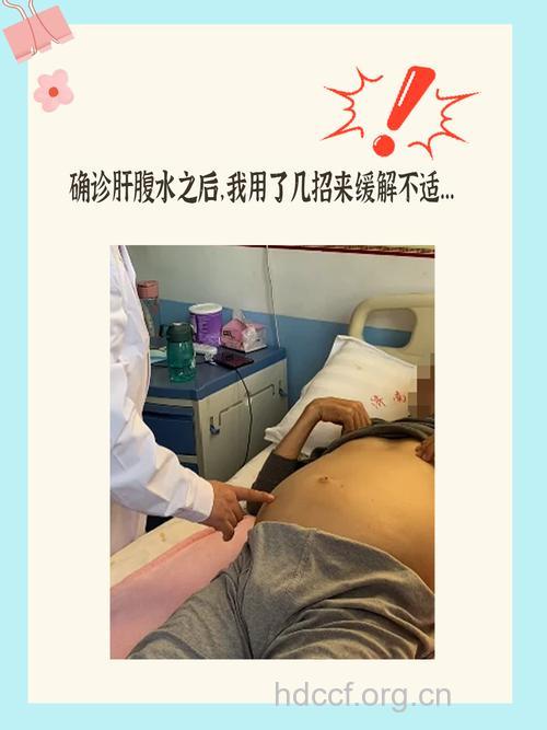 肝腹水患者发热有哪些应对方法